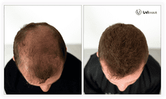 UVI Hair vlakna za kosu, DARK BROWN / Tamno smeđa (velika 27,5 g, do 50 nanosa)