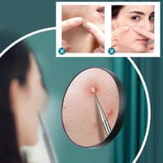 FRILLA® Alat za uklanjanje mitesera i prištića s kutijom, nehrđajući čelik | PORACLEAN