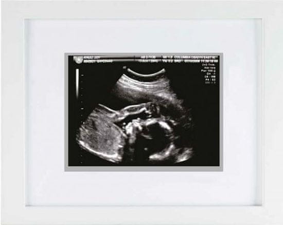 Pearhead okvir - Sonogram slika